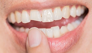 Closeup of smile with chipped tooth