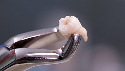 Metal clasp holding extracted tooth