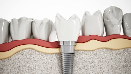 Animation of implant supported tooth