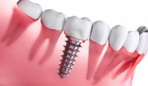 Animated implant supported dental crown