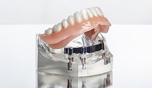 Model implant supported denture