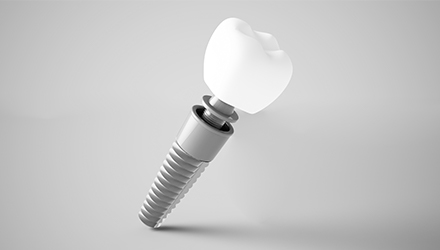 Animated dental implant replacement tooth components