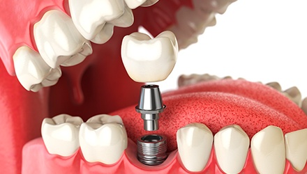 Animation of dental implant placement